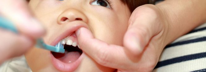 What to do if your toddler has tooth decay