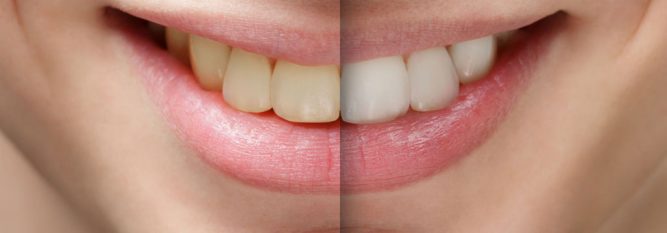 Simple facts about tooth whitening