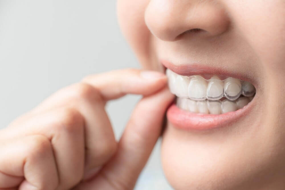Macquarie Dentists - a woman wearing Invisalign